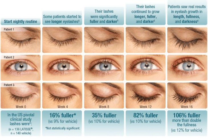 Latisse® Eyelash Enhancements