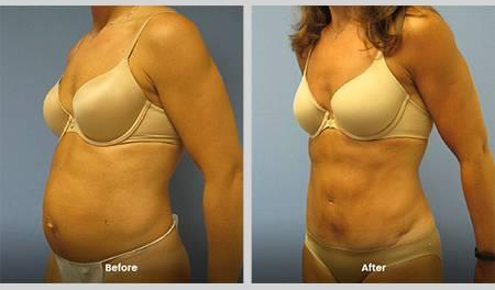 Variations in Tummy Tuck Surgery for NJ Patients
