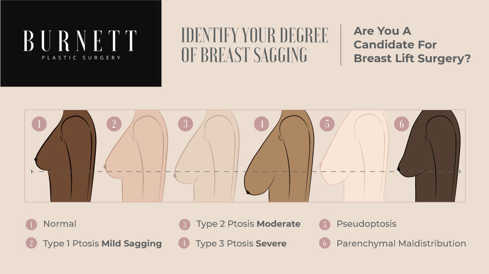 Women considering a breast lift can determine their degree and type of sagging with help from Westfield, NJ's Burnett Plastic Surgery.