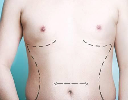 How Does Male Breast Reduction Work?