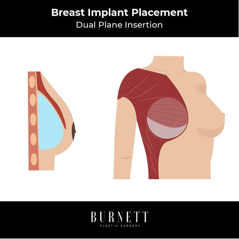 Explore the dual plane technique for breast augmentation with Westfield, NJ's Dr. Carlos Burnett.