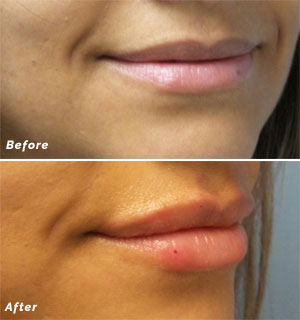 Lip Filler before and after