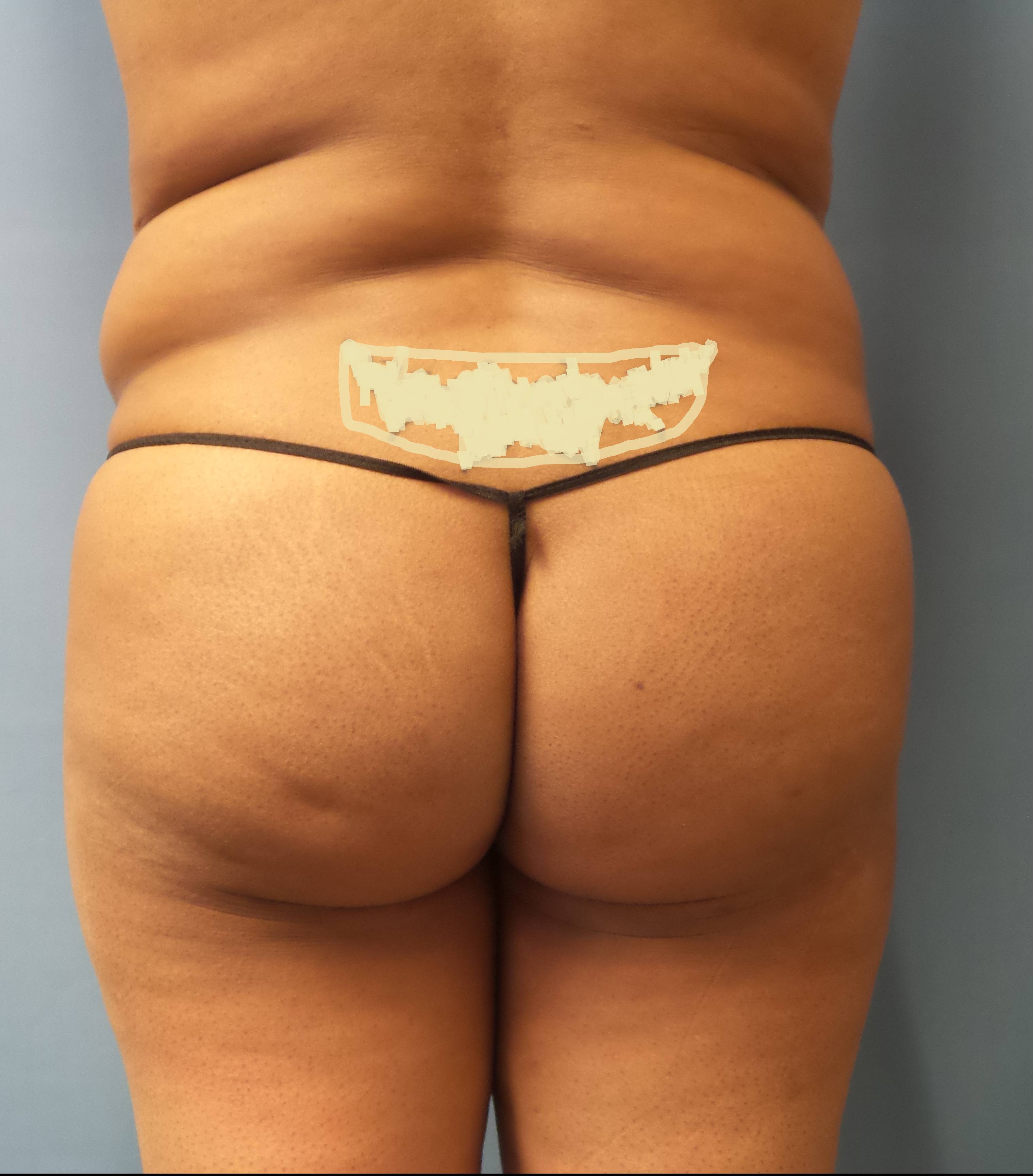Large Volume BBL Fat Transfer and Body Contouring, NJ